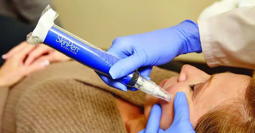 Afsløringen af Skønheds Hemmelighed: Miraklerne ved Microneedling