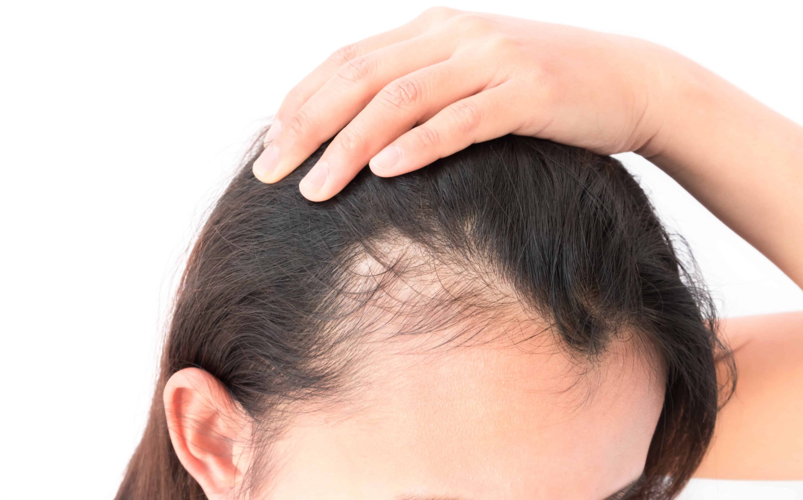 Alopecia Treatment Market is Estimated to Witness High Growth Owing to Opportunity of Rising Incidences of Alopecia