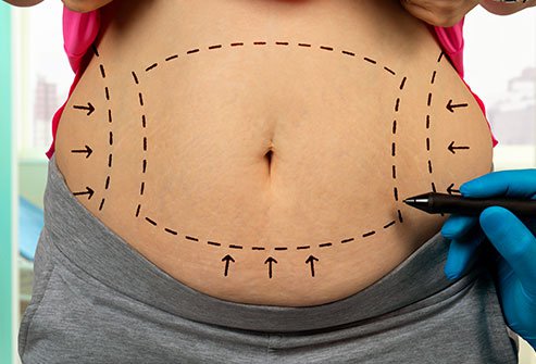 Top 5 Factors Affecting Tummy Tuck Surgery Cost in Punjab