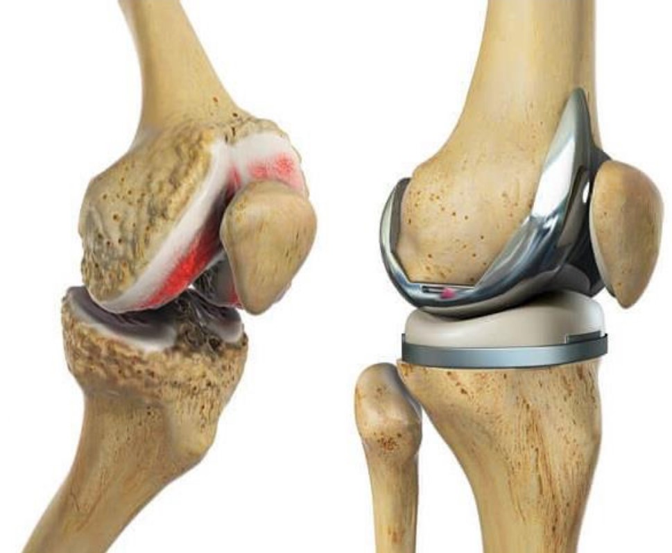 Knee Replacement Market Size, Sales, Forecast & Analysis 2032